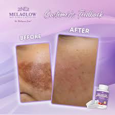 2ne2 Melaglow Melasma 30 Capsules