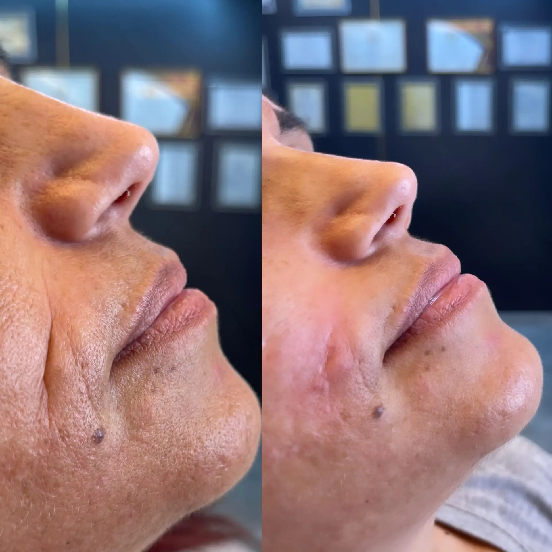 הזרקות בוטוקס בפתח תקווה ובכרמיאל | San.clinic