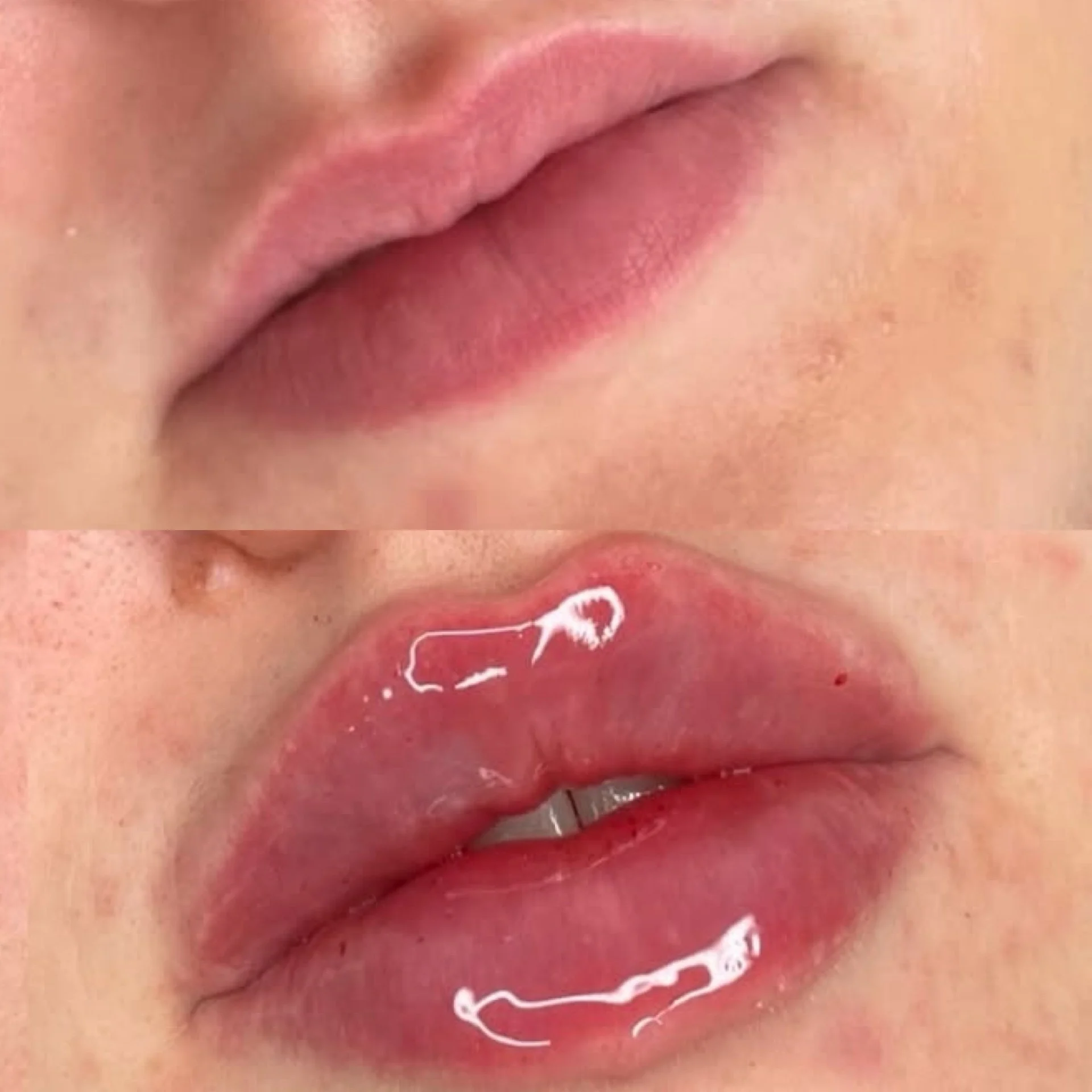 הזרקות חומצה היאלורונית | San.clinic