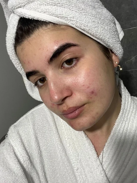 חבילת אקנה בייסיק