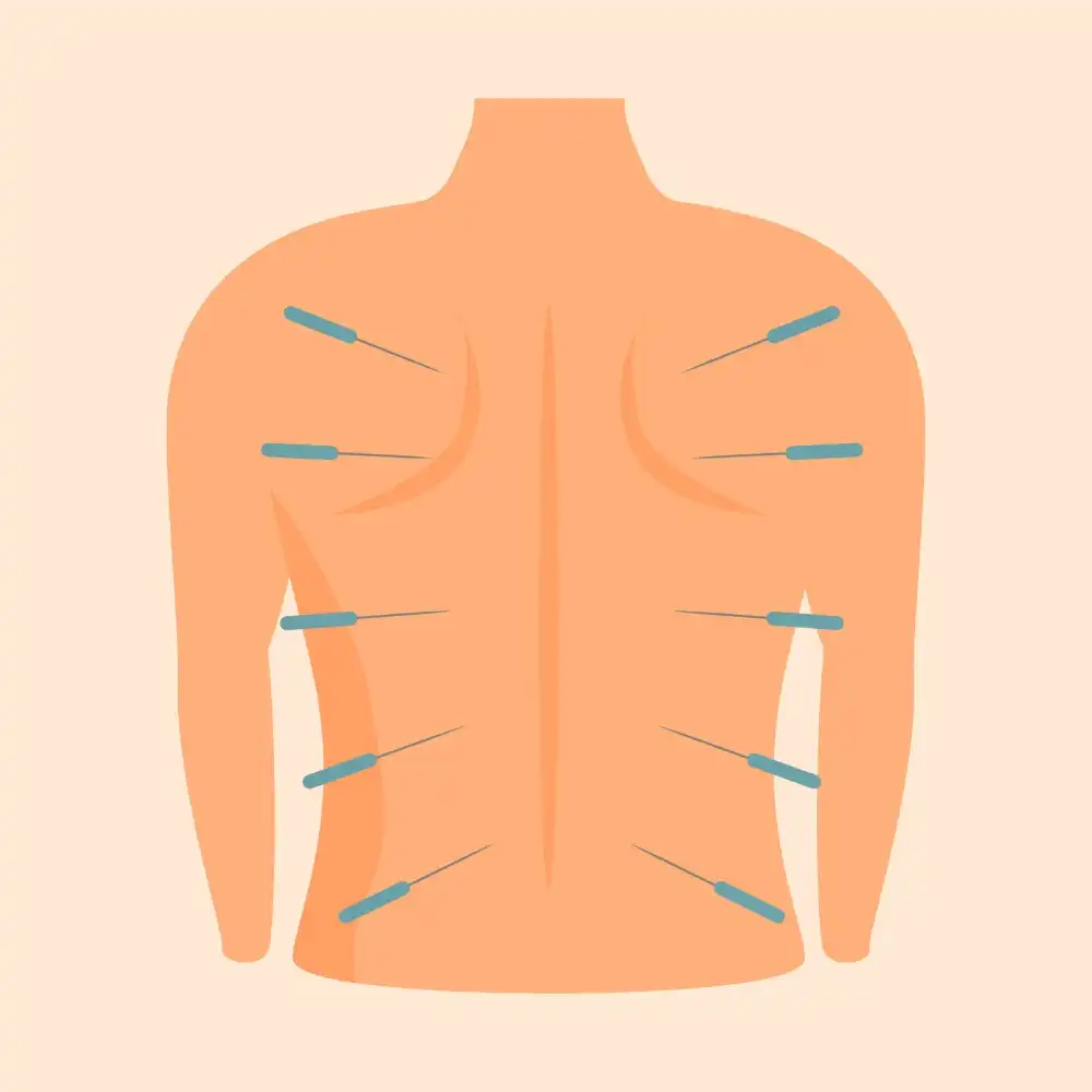 טיפול דיקור יבש