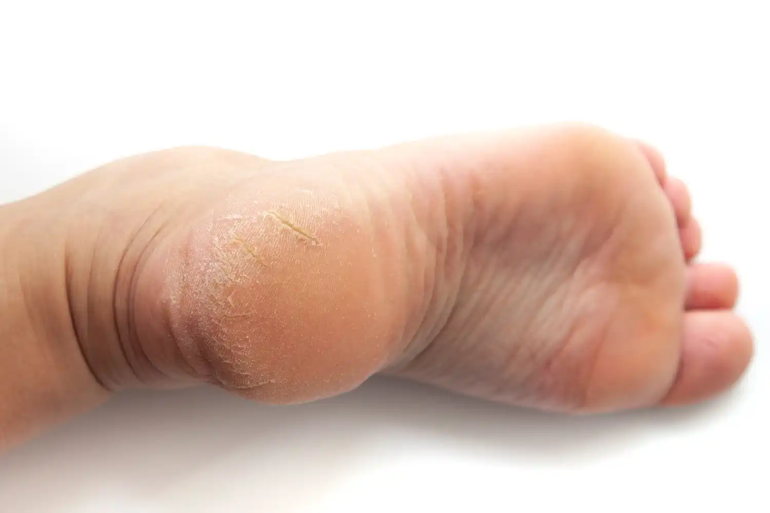 טיפול בסדקים וחבישה מיוחדת