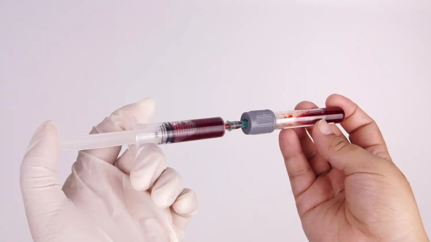 טיפול PRP בקרית אתא – התחדשות טבעית לעור | ד"ר אירינה נודליס