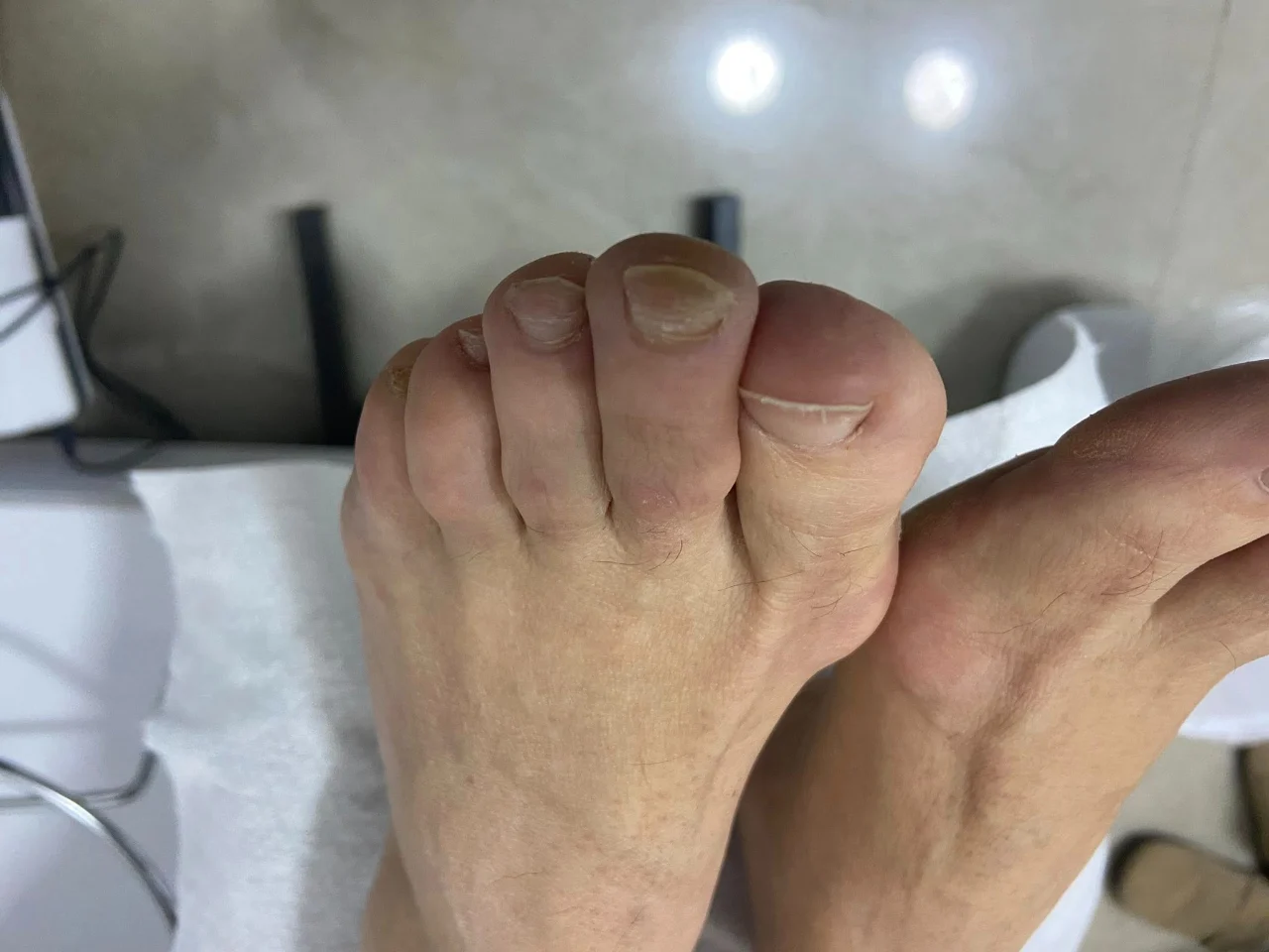 טיפול בפטרת ציפורניים