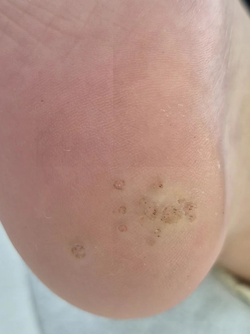 טיפול ביבלת ויראלית