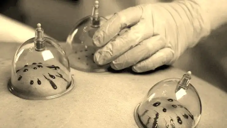 הקזת דם לטיפול בכאבים 