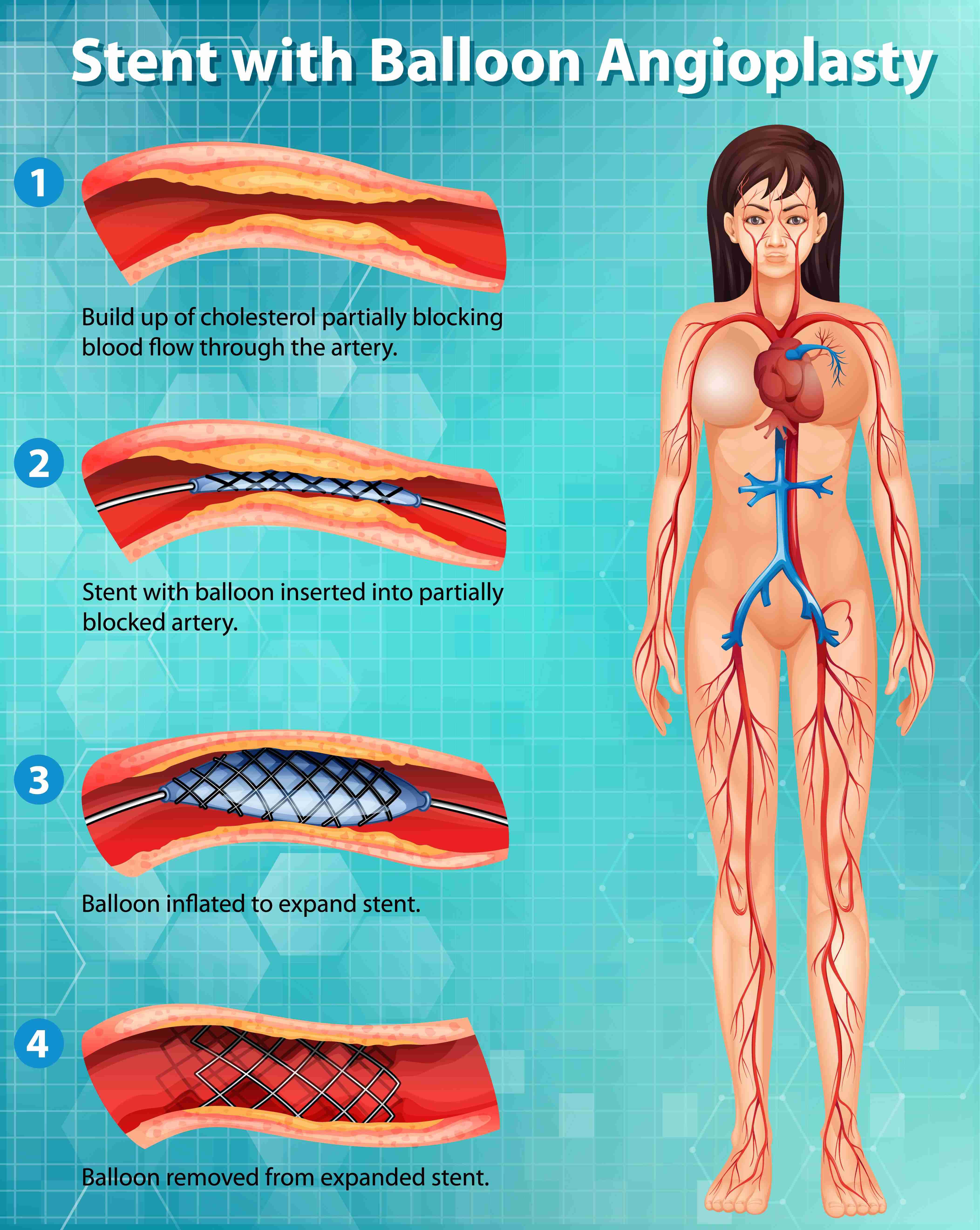  Diagram showing arteries in the arms and legs with a catheter inserted for imaging.