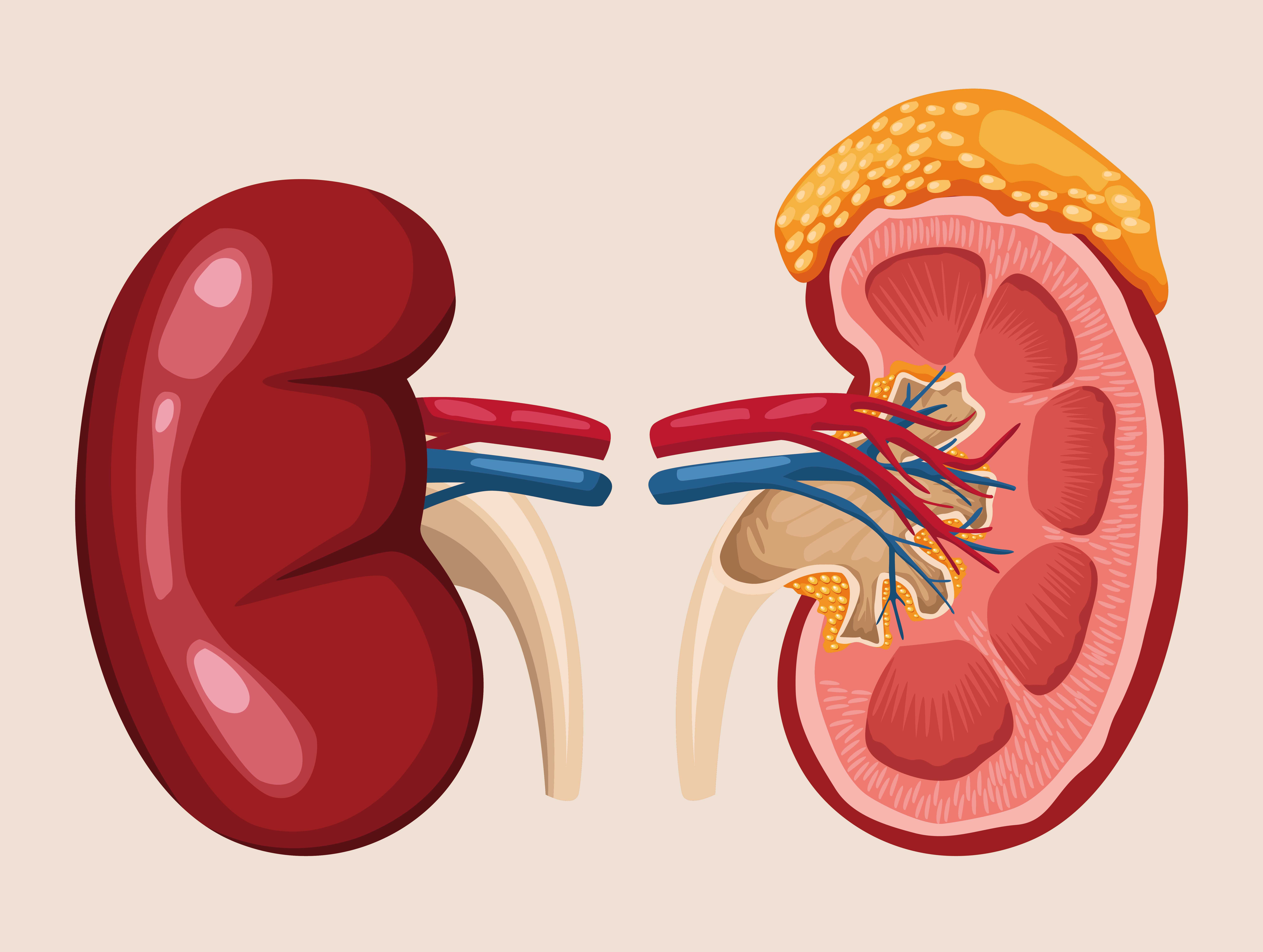 Comparison image showing healthy kidneys next to diseased kidneys.