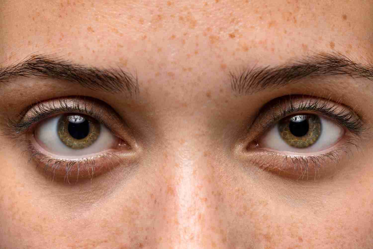 Close-up of an eye showing Bitot’s spots—small white patches on the conjunctiva