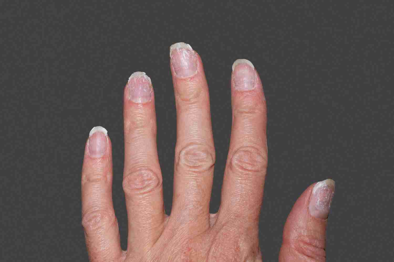 A collage showing various nail issues: ridges, discolouration, pitting, and thickened nails.