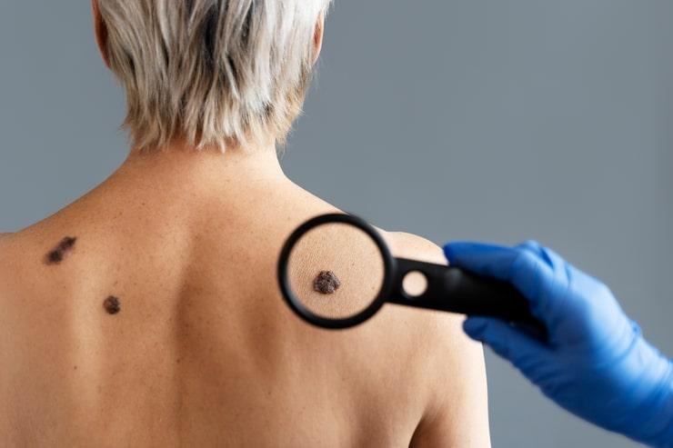 All the Information You Need About Wart Removal Surgery