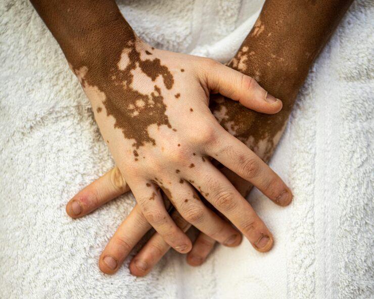 Managing Vitiligo: Latest Medical and Surgical Treatments