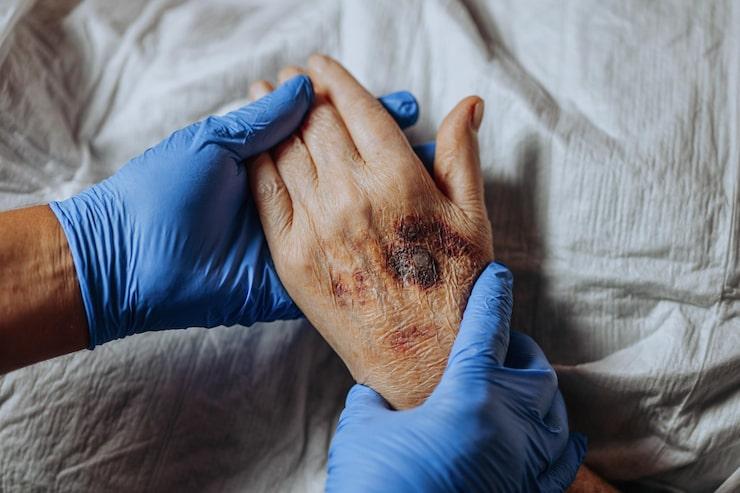 doctor examining the hand of someone with Vitiligo