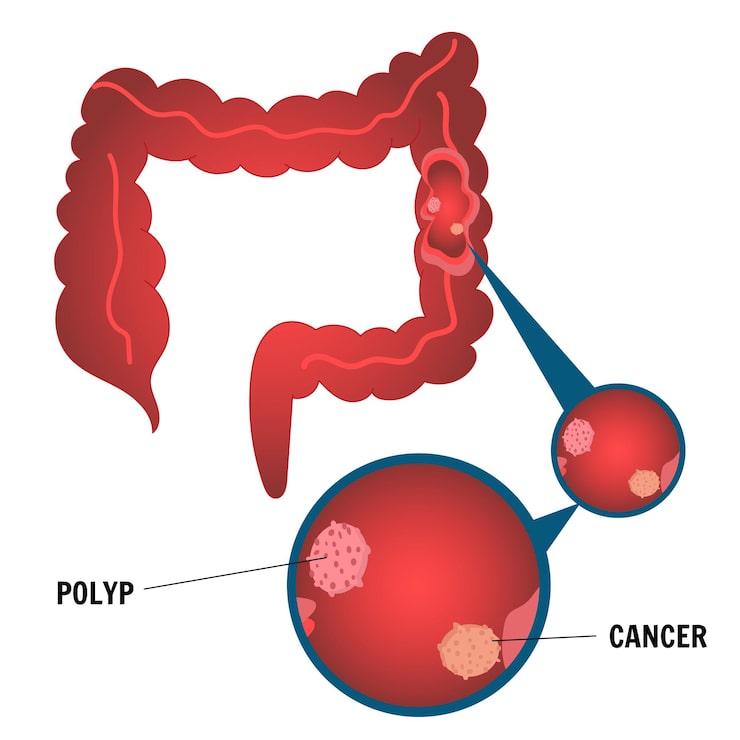 Image displaying how polyps are different from cancer