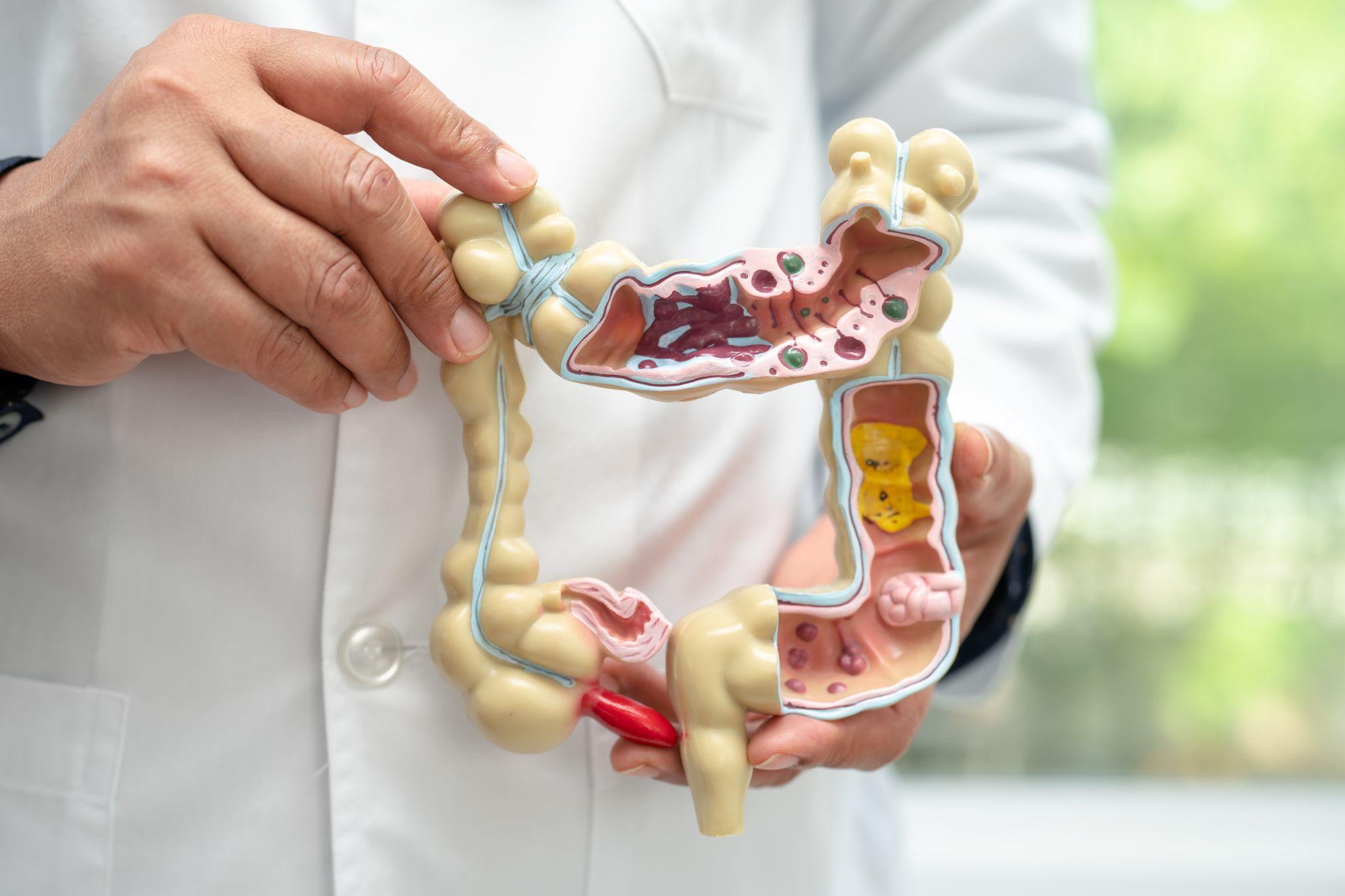 an anatomical model of the intestine displaying Polyps