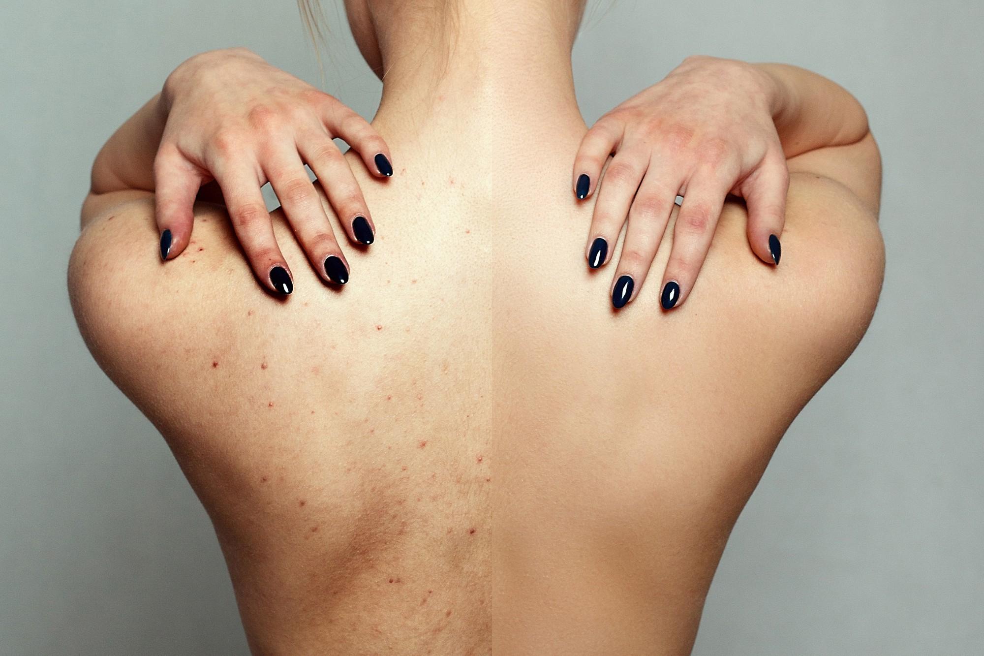  Birthmark Removal Options: From Lasers to Surgery