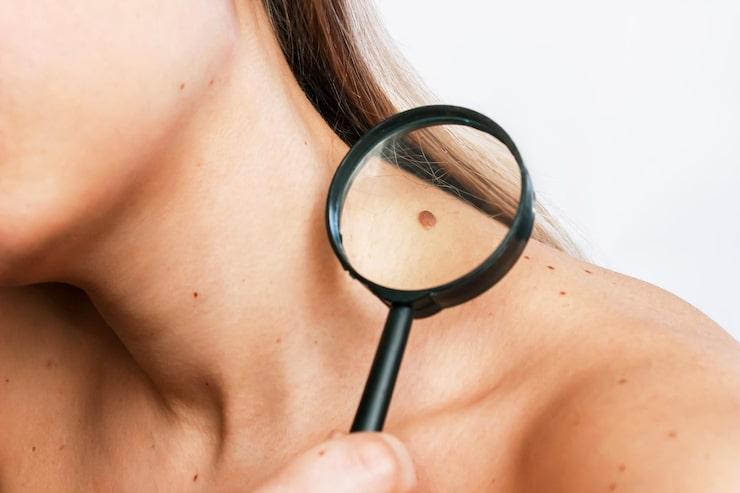 woman examining her birthmarks