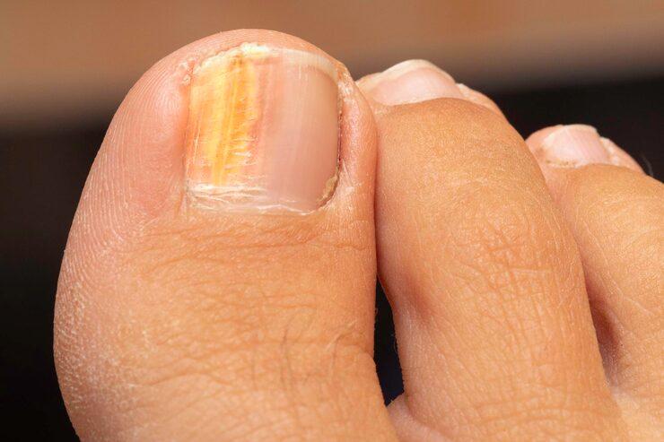 Nail Surgery: Ingrown Toenails and Other Common Procedures