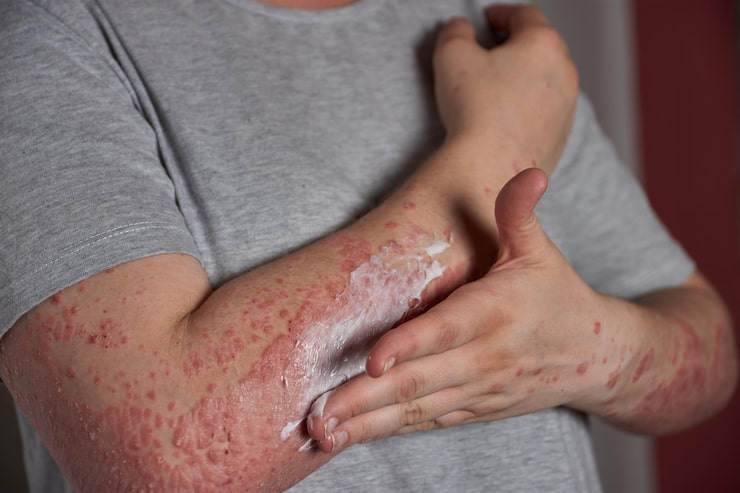 Signs, symptoms, and treatment options for Psoriasis