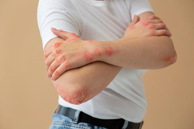 person with psoriasis with clear signs