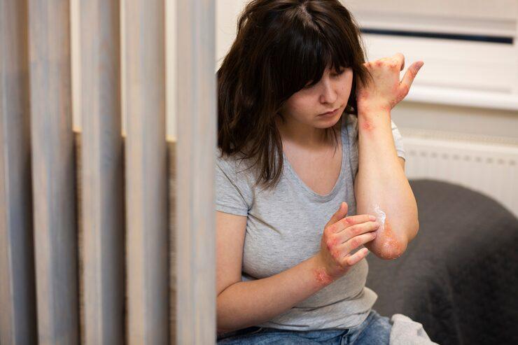 person with psoriasis taking care of their condition