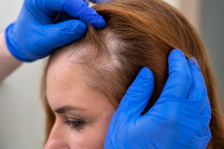 person suffering from hair loss getting it checked by a doctor