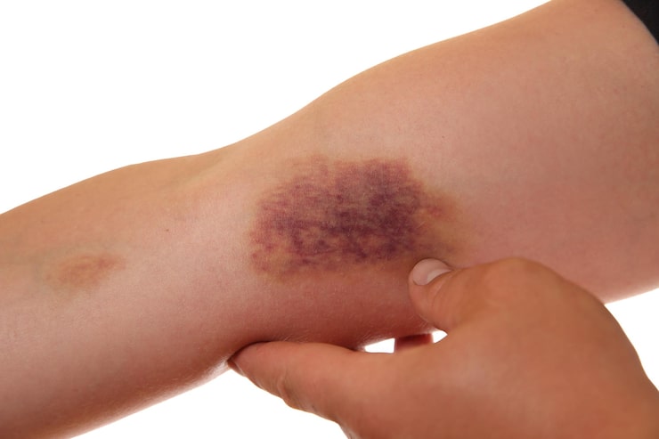 Understanding Hematoma: Causes, Symptoms, and Treatment at Prakash Hospital, Noida