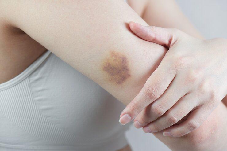 hematoma on someone’s arm