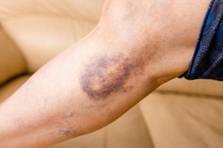 hematoma on a person