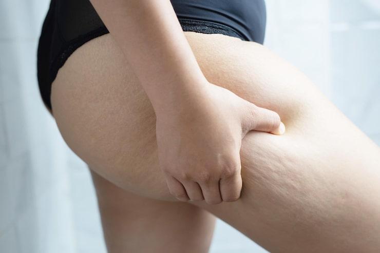 cellulitis in the thigh area