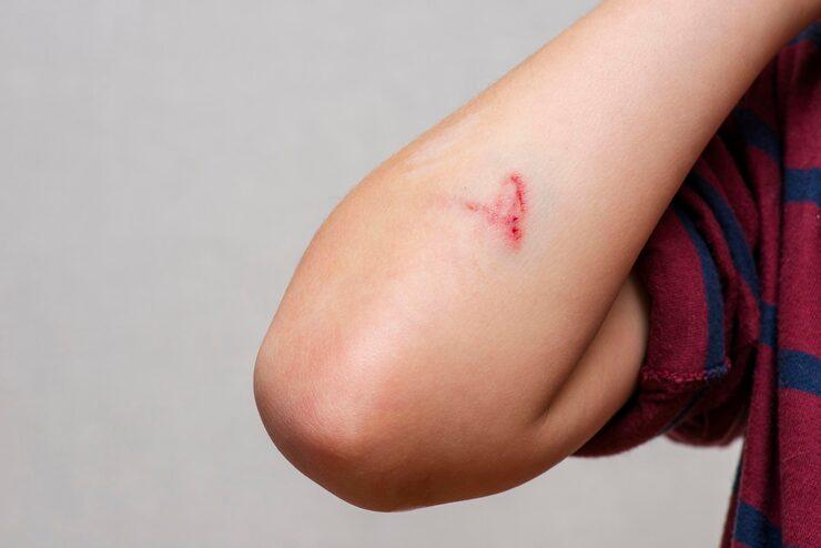 Necrotizing Fasciitis: The Flesh-Eating Infection That Spreads Quickly