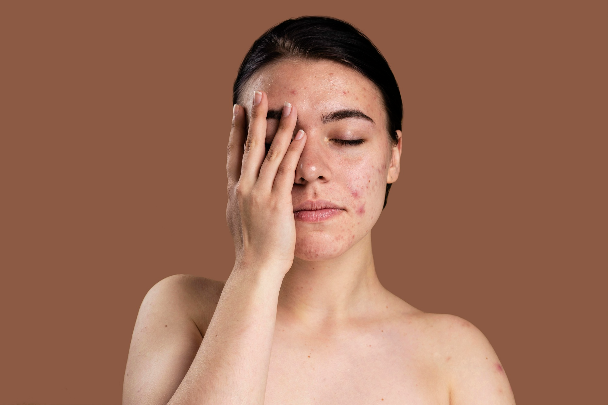 Acne in Adulthood: Causes, Treatments & When to See a Dermatologist