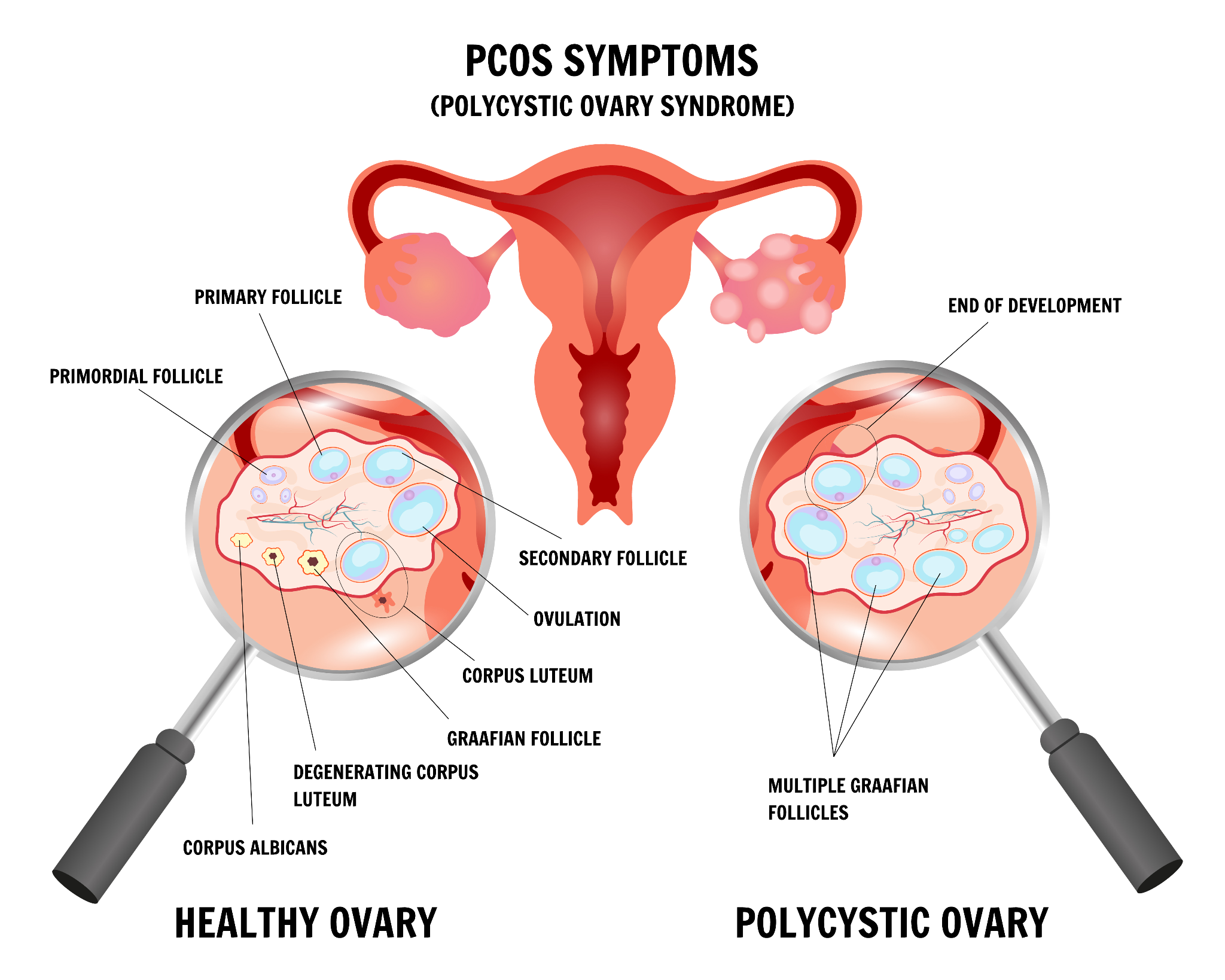 A medical infographic of the difference between a healthy ovary and a polycystic ovary.
