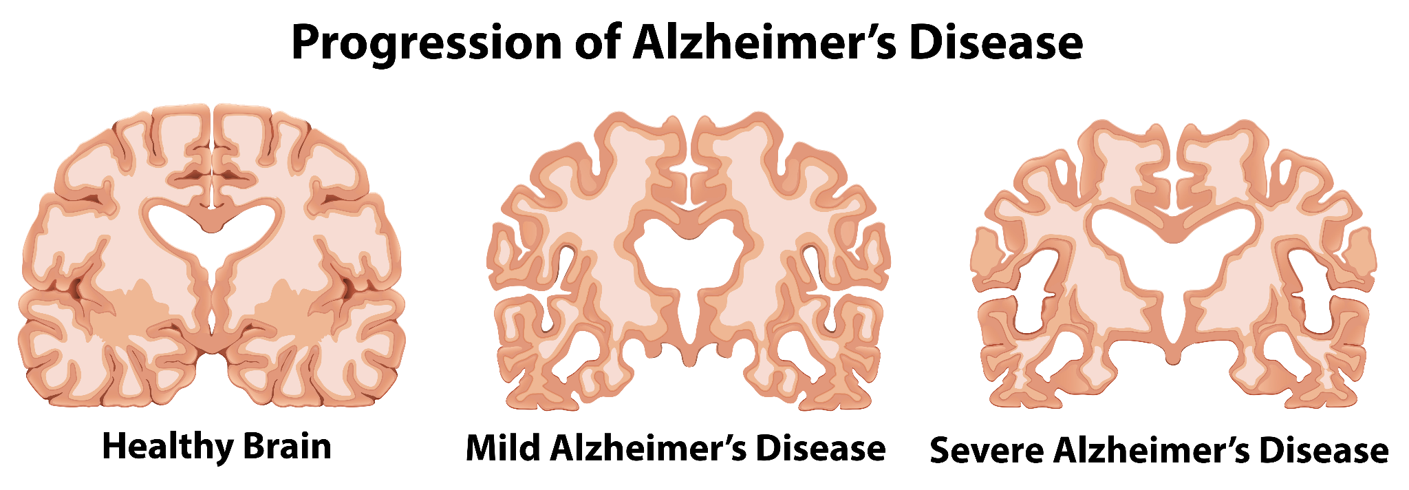 3 diagrams of the way the brain looks after being affected with Alzheimer’s Disease, with a healthy brain, mild Alzheimer's and severe Alzheimer’s Disease.
