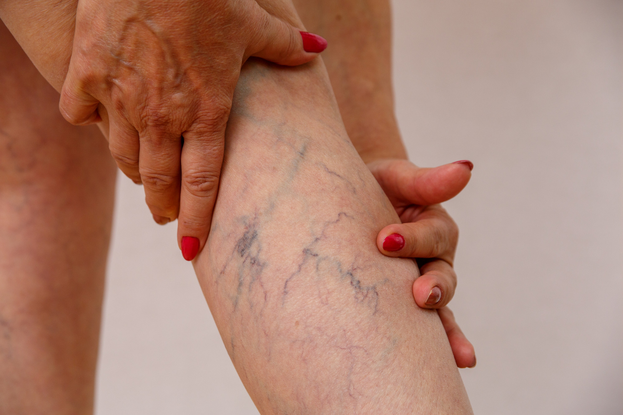 How to Prevent Varicose Veins and Leg Swelling