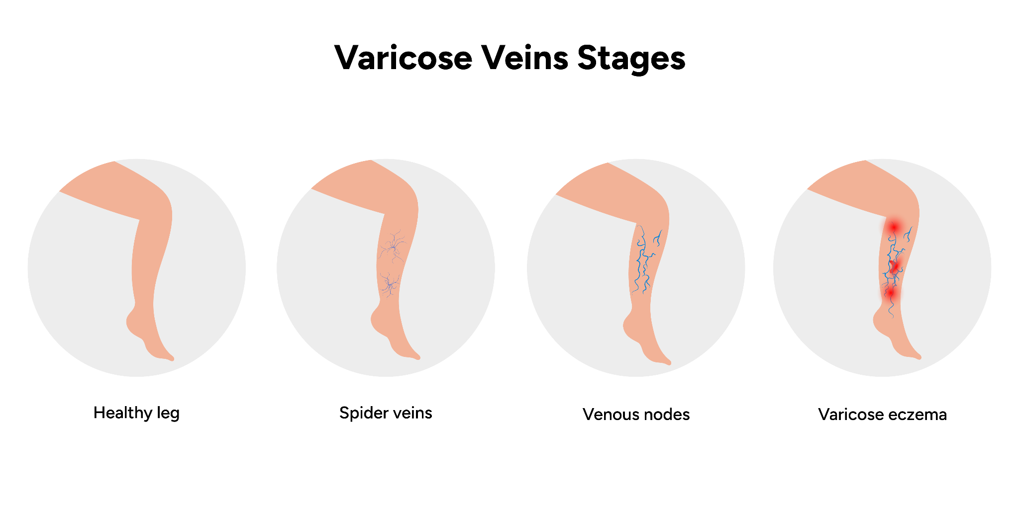 An infographic showing the different stages of varicose veins, from early spider veins and venous nodes to advanced swollen and painful bulging veins with varicose eczema.