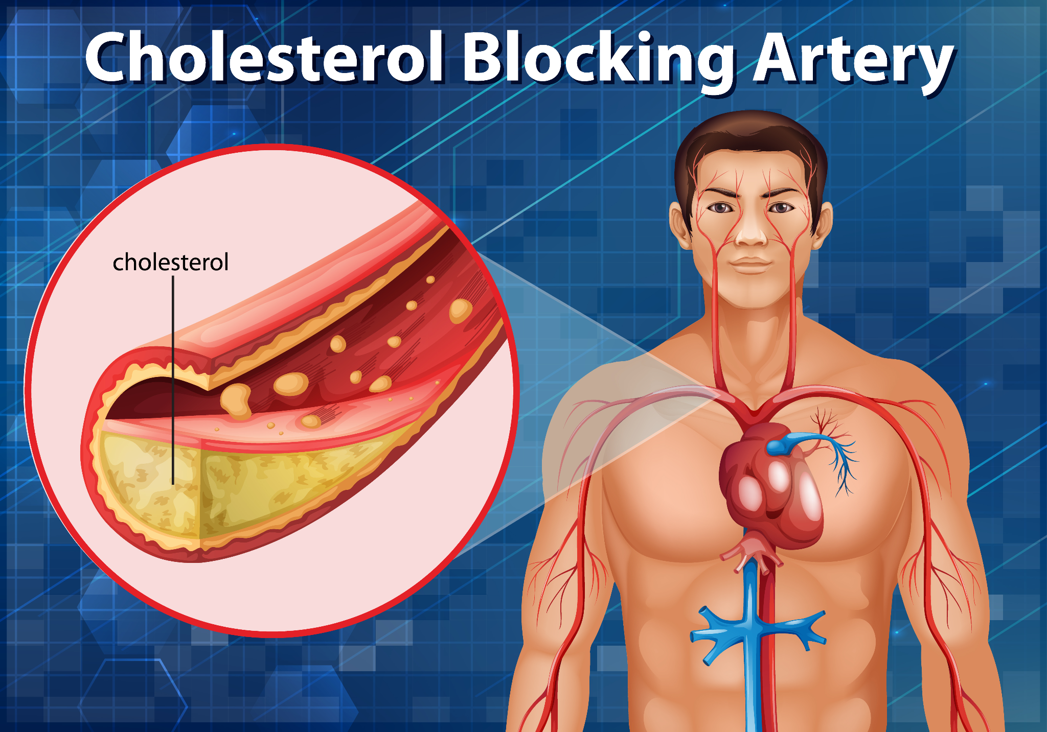 An infographic illustrating how excessive LDL (bad cholesterol) leads to plaque accumulation in arteries, narrowing blood flow.