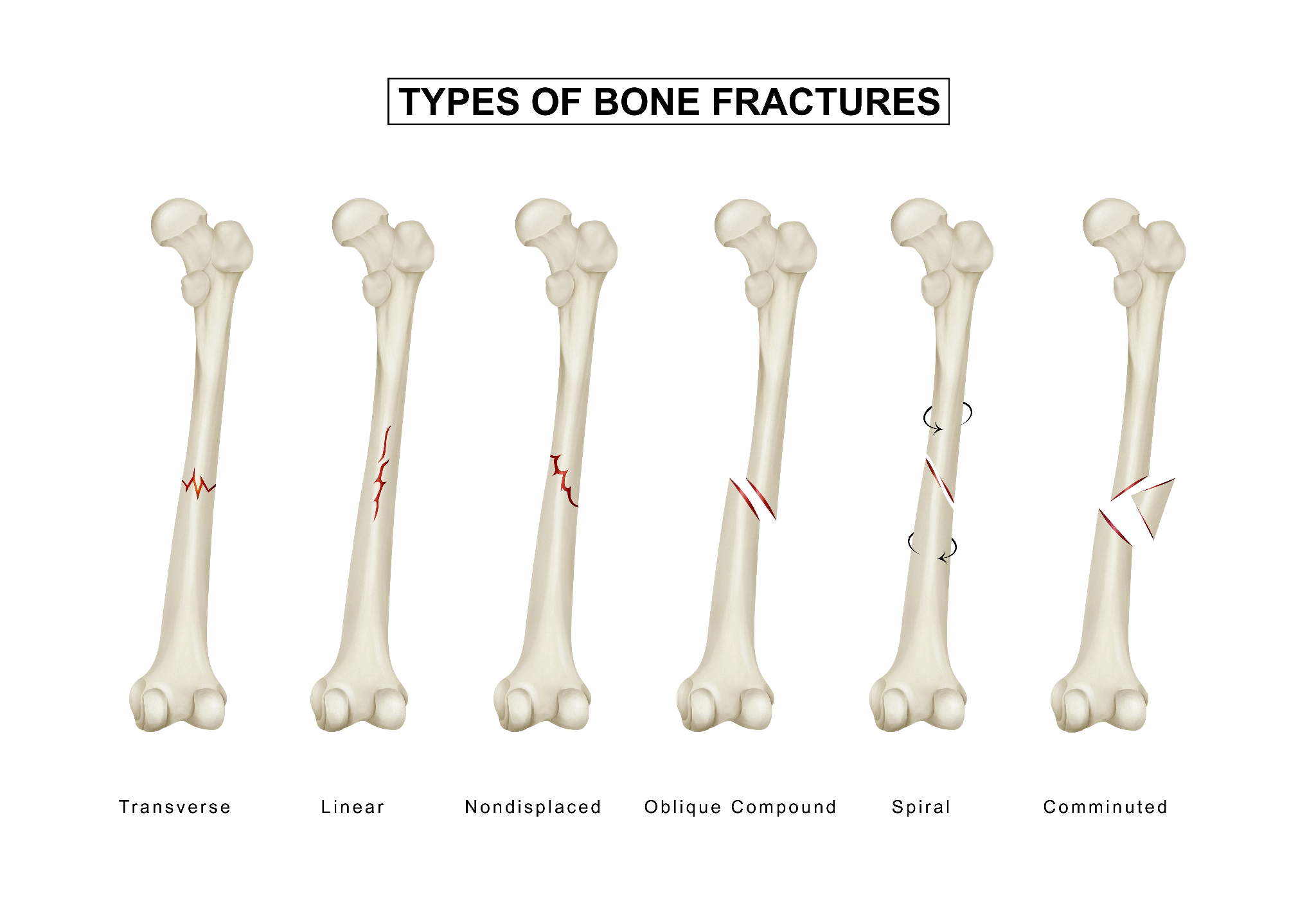 An infographic illustrating different types of bone fractures, including simple, compound, greenstick, and comminuted fractures for easy understanding.