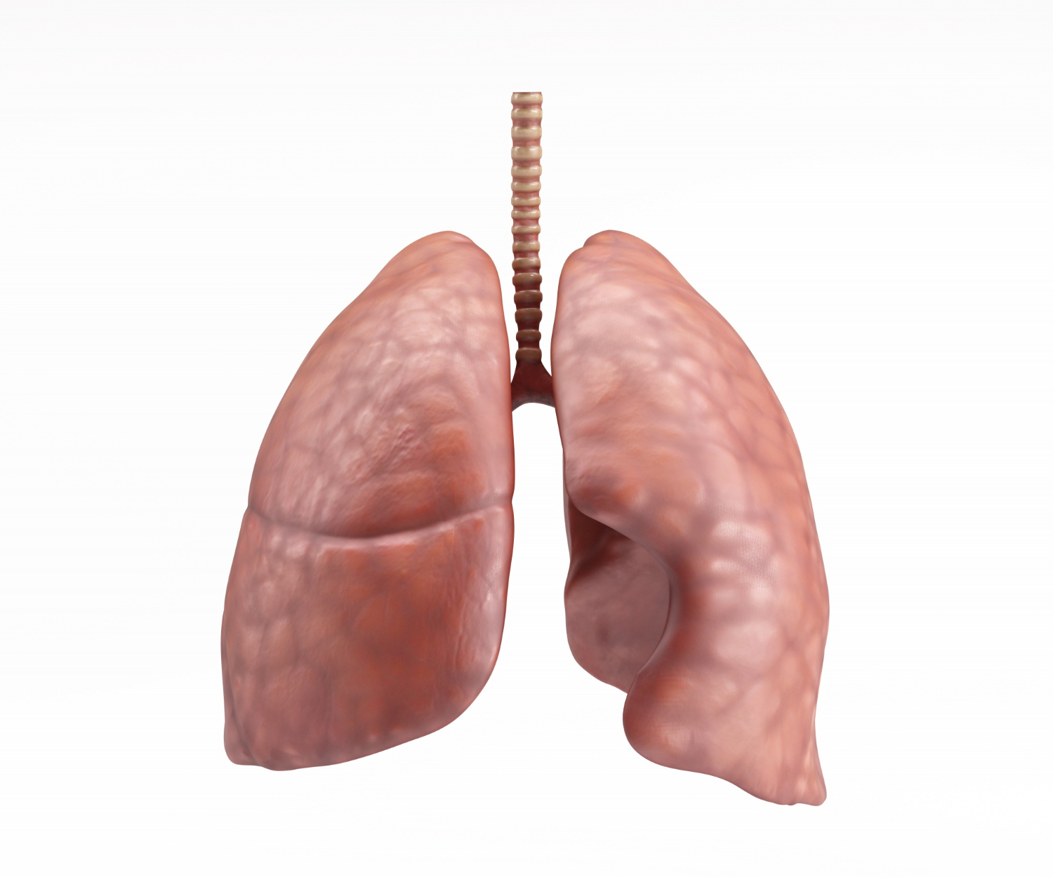  A 3D medical illustration of the human lungs highlighting a tumor on the left lobe.