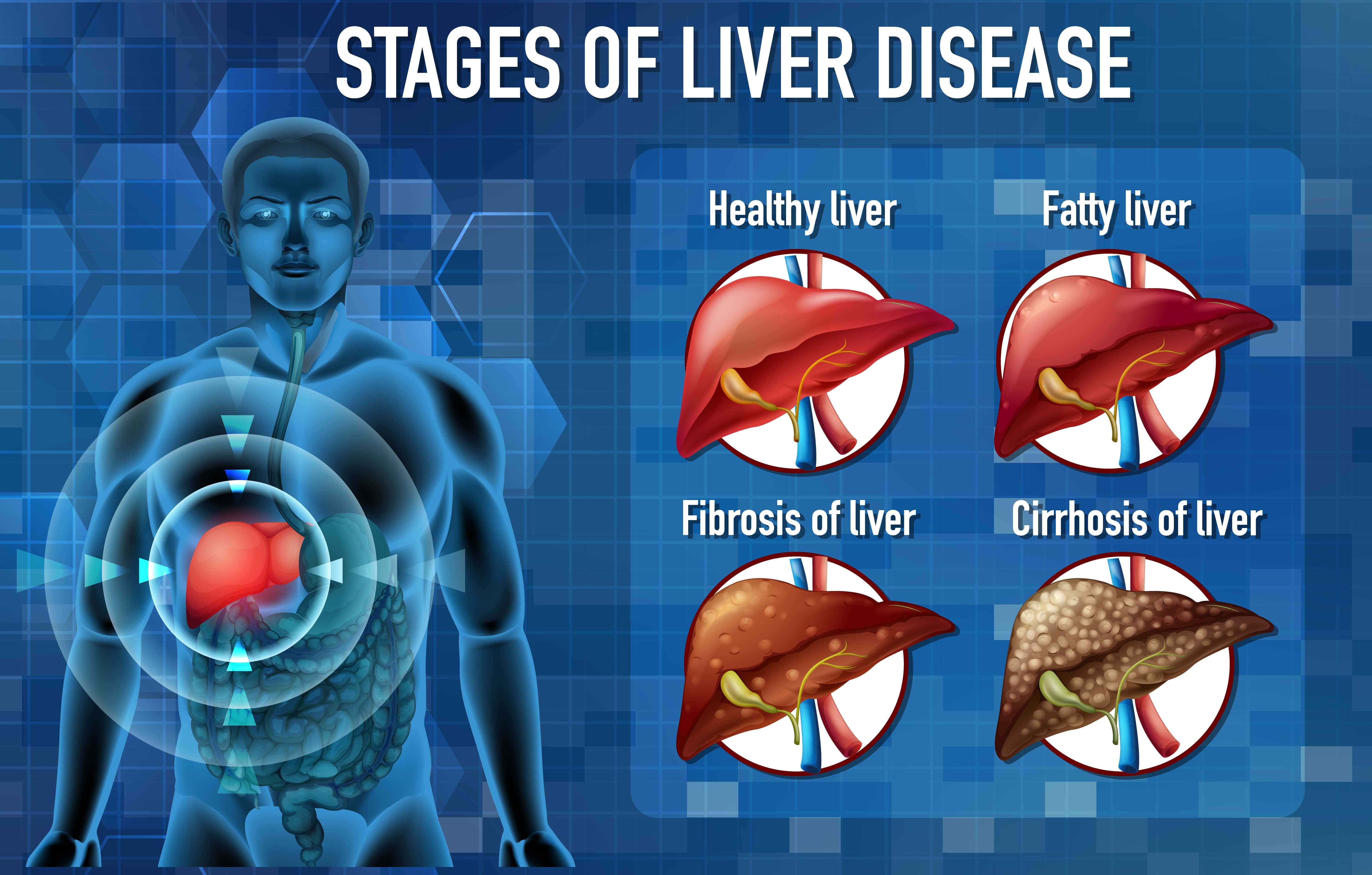  A 3D medical illustration showing an inflamed liver surrounded by virus particles, highlighting the effects of hepatitis on liver function.