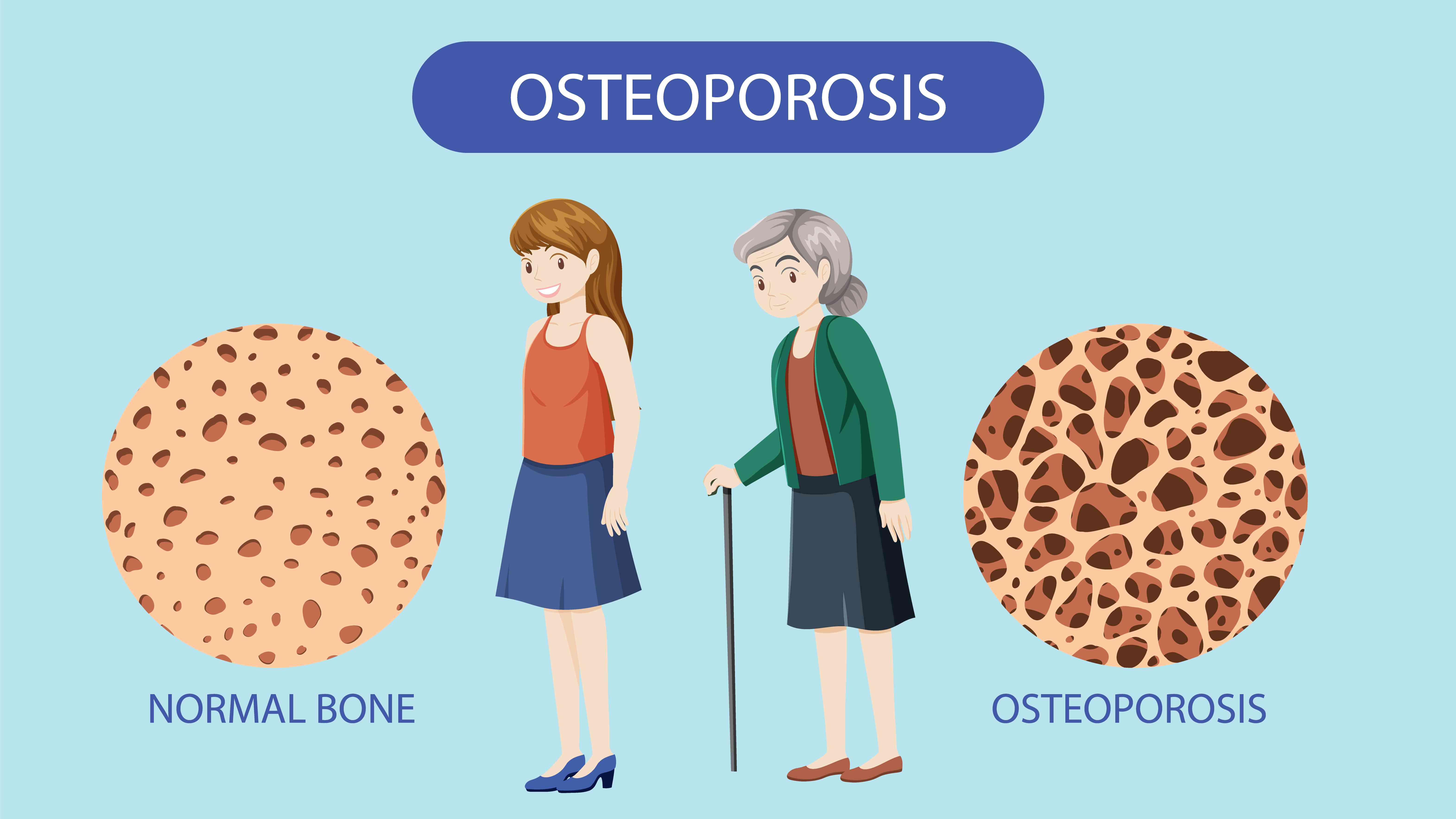Osteoporosis in Women: Silent Symptoms You Shouldn’t Ignore