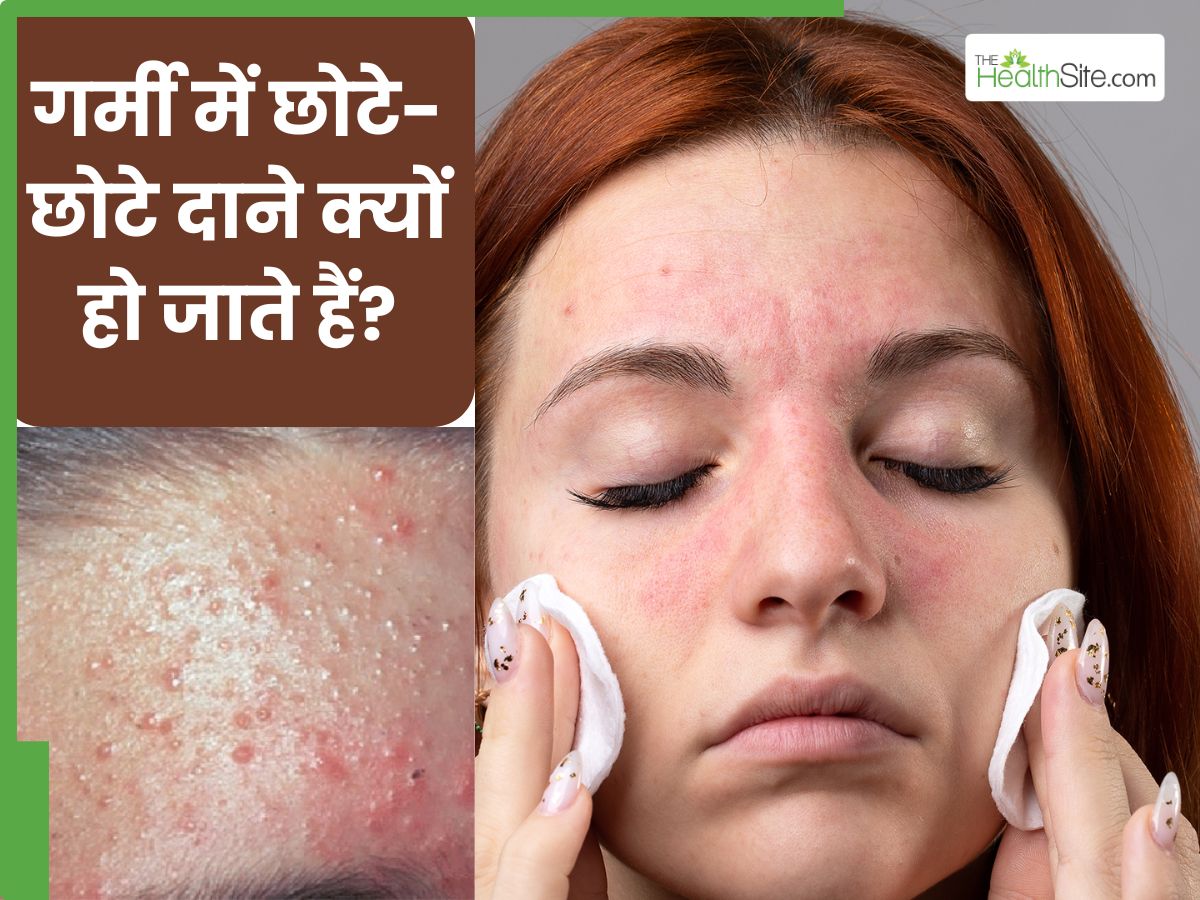 गर्मियों में चेहरे पर छोटे-छोटे दाने क्यों हो जाते हैं? डॉक्टर से जानें इसके 7 कारण
