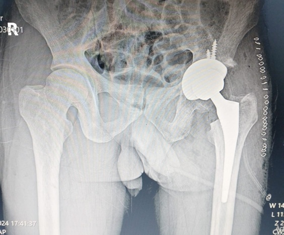 Hip TB and AVN: Restoring Mobility in Nursing Officer