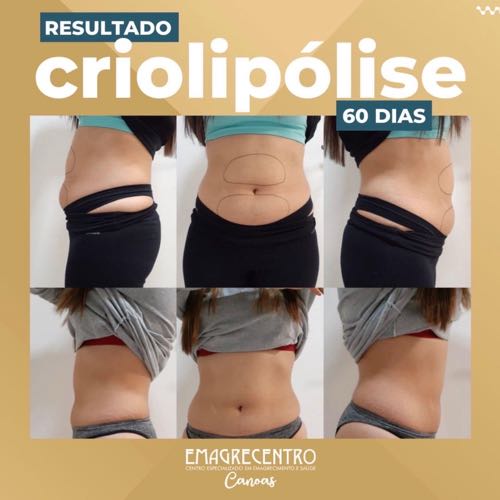 Emagrecentro Canoas (Tratamento Corporal)