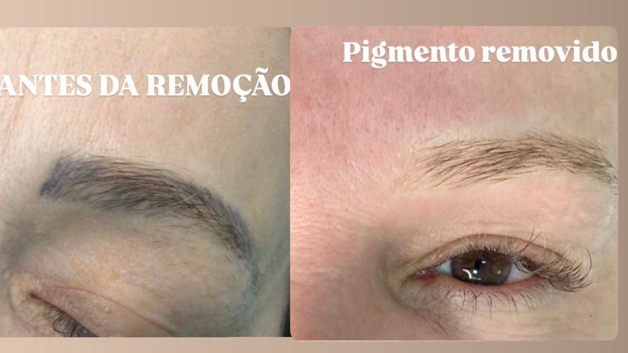 Belfort Beauty (Remoção de Laser)