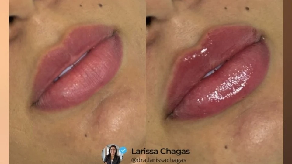 Dra. Larissa Chagas - Harmonização Facial e Corporal 