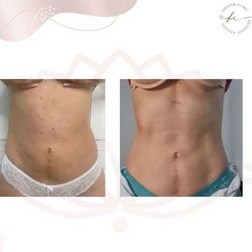 FC Estética Avançada (Pós Operatório De Cirurgia Plástica)