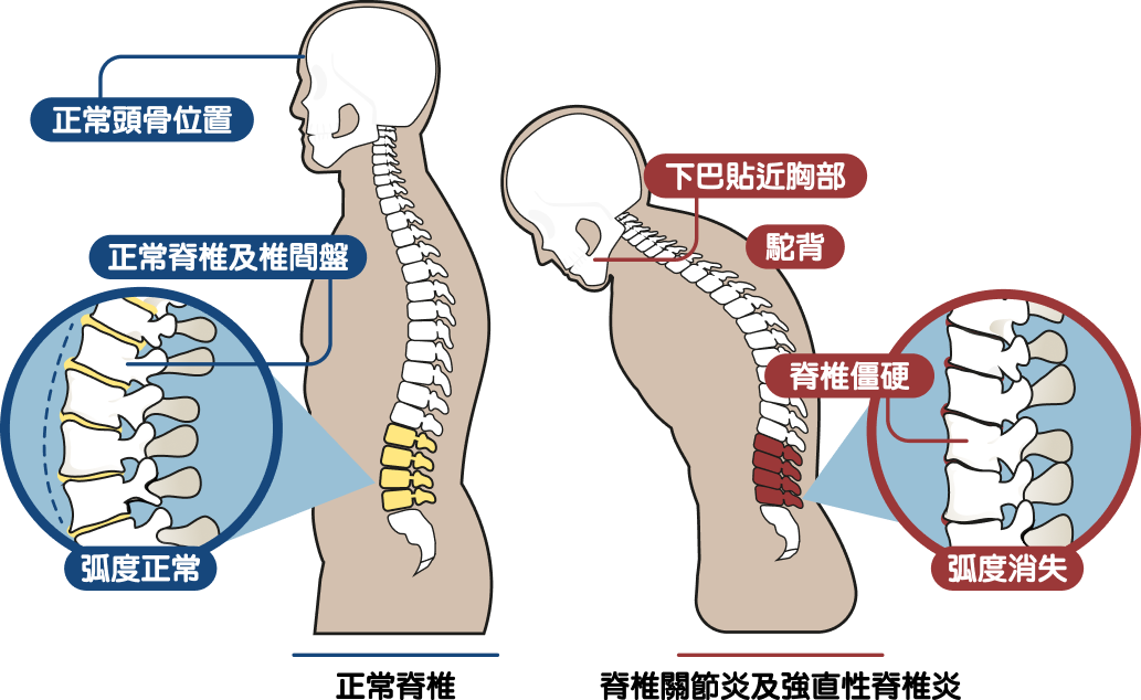 甚麼是脊椎關節炎及強直性脊椎炎？