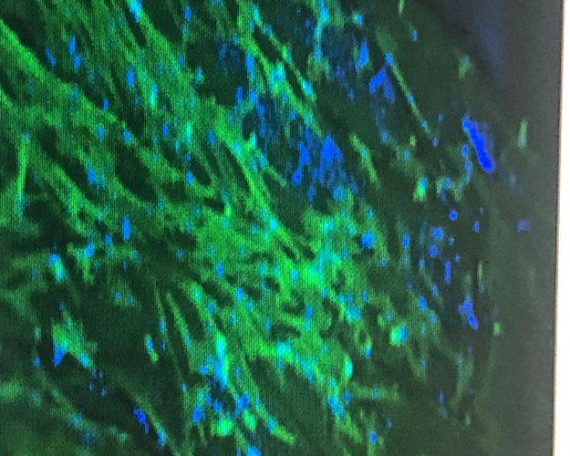 Thumbnail supplied by the source for Regenerative Treatment of SUI by Autologous Macrophage Therapy