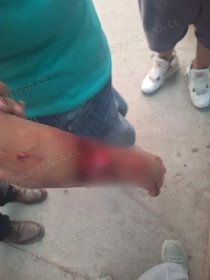 Adulta mayor con discapacidad resulta con severa lesión tras brutal ataque de perro en Melipilla